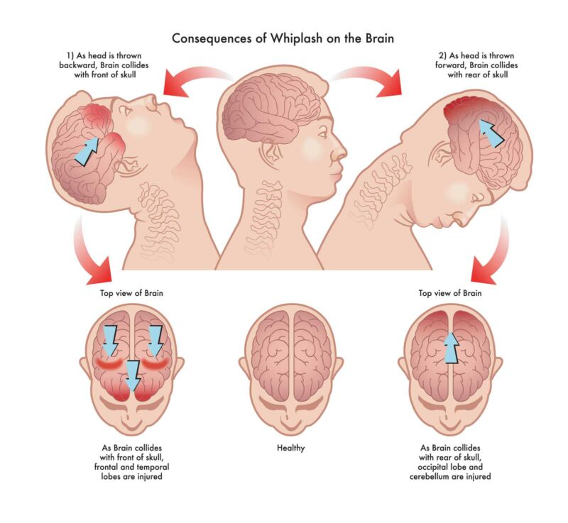 Understanding Your Body's Response to a Car Accident Total Vitality